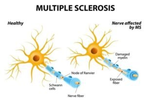 Multiple Sclerosis (MS) Treatment in Faridabad - Dr. Kunal Bahrani