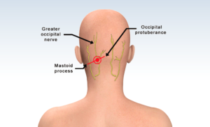 GON Blocks (Greater Occipital Nerve Blocks)