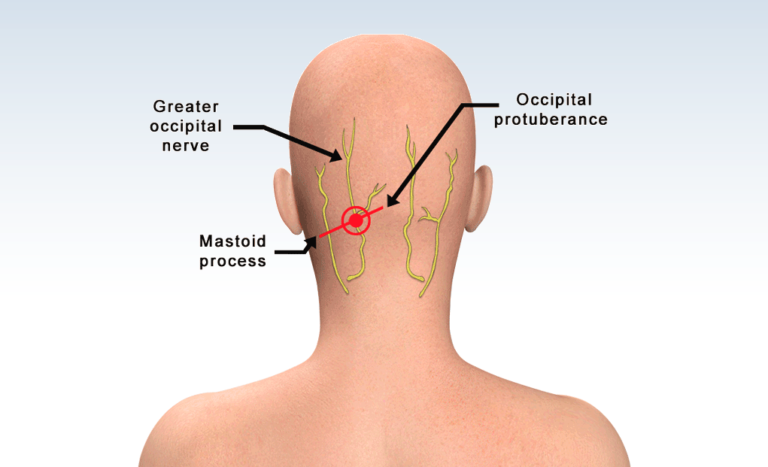 GON Blocks (Greater Occipital Nerve Blocks) To Alleviate Migraine