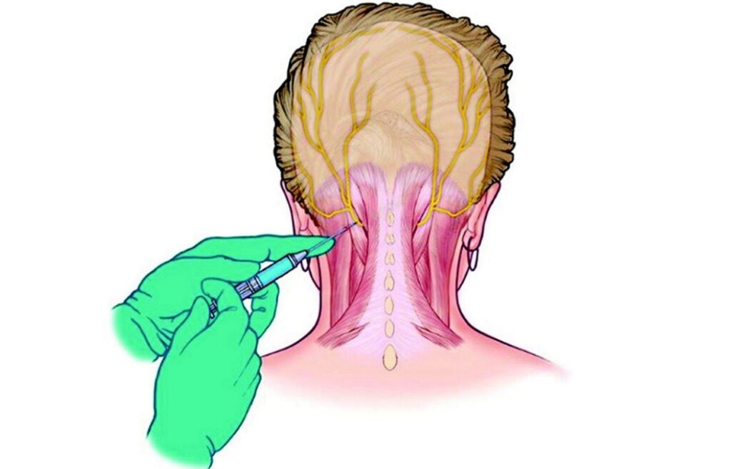 Nerve Blocks the Future of Headache Treatment