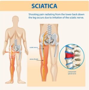 Best Sciatica Doctor in Faridabad – Dr. Kunal Bahrani