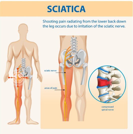 Best Sciatica Doctor in Faridabad – Dr. Kunal Bahrani